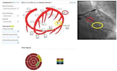 Anatomical Assessment vs. Pullback REsting full-cycle rAtio (RFR) Measurement for Evaluation of Focal and Diffuse CoronarY Disease: Rationale and Design of the “READY Register”